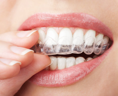 Invisalign Clear Braces Near Me in Toledo, OH